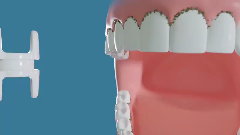 Miracle Smile Magic Flosser